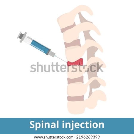 Spinal injection. Spinal Injections can be performed to diagnose the source of pain or as a treatment to relieve pain. Syringe injection into spinal disk.Treatment of back pain or other pathology.