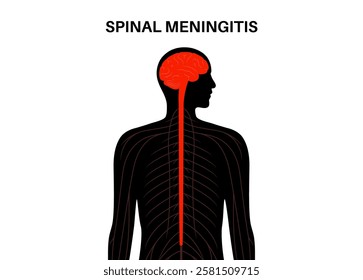 Spinal meningitis inflammation of the protective layers surrounding the brain and spinal cord. Meninges disease poster. Bacteria, viruses, fungi, parasites in the human head flat vector illustration