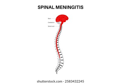 Spinal meningitis inflammation of the protective layers surrounding the brain and spinal cord. Meninges disease poster. Bacteria, viruses, fungi, parasites in the human head flat vector illustration