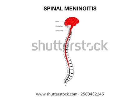 Spinal meningitis inflammation of the protective layers surrounding the brain and spinal cord. Meninges disease poster. Bacteria, viruses, fungi, parasites in the human head flat vector illustration