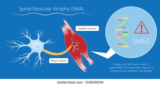 Spinal Muscular Atrophy SMA Genetic Disorder Child Weak