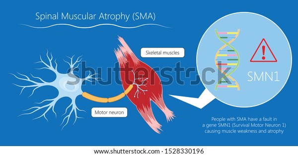 Spinal\
muscular atrophy SMA genetic disorder child\
weak