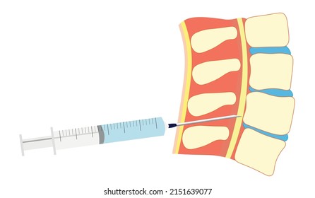 Spinal Needle Position In A Spinal. Spinal Injection With A Syringe  