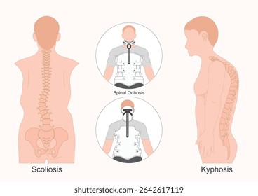A spinal orthosis also known as a back brace or neck brace is an external device used to support immobilize or correct the spine.Milwaukee brace or TLSO. Medical equipment, vector illustration.