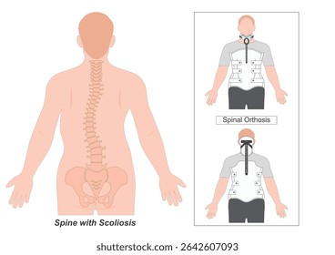 Spinal Orthosis that spans the thoracic, lumbar and sacral spine. It is used to provide post-traumatic and post-surgical stabilization.Milwaukee brace or TLSO. Medical equipment, vector illustration.