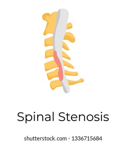 Spinal Stenosis, Flat Vector Icon 