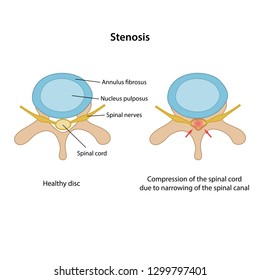 Spinal stenosis with main description. Healthy disc and disc with spinal stenosis in superior view are isolated on white background. Vector illustration