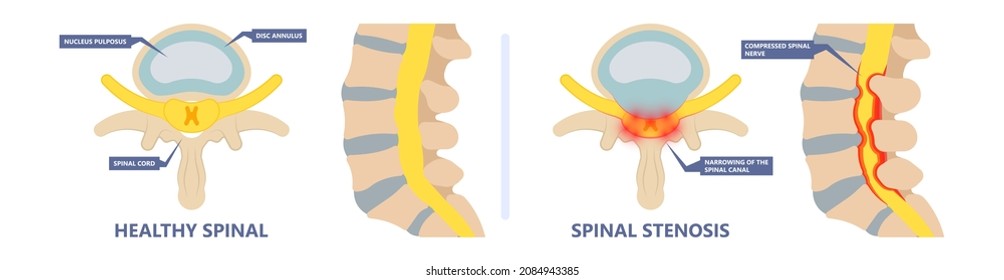 Spinal stenosis a narrowing of the spaces of the spine that causes lower back pain annulus nucleus bulged older cord muscle weakness neck cauda equina injury cushioning  vertebrae disk bone