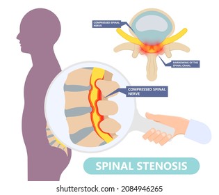 Spinal stenosis a narrowing of the spaces of the spine that causes lower back pain