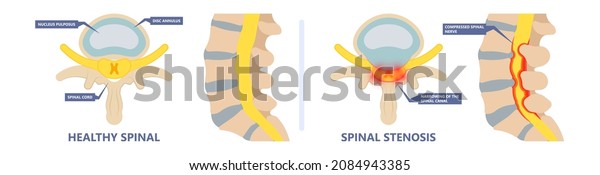 Spinal stenosis a narrowing of the spaces of the\
spine that causes lower back pain annulus nucleus bulged older cord\
muscle weakness neck cauda equina injury cushioning  vertebrae disk\
bone