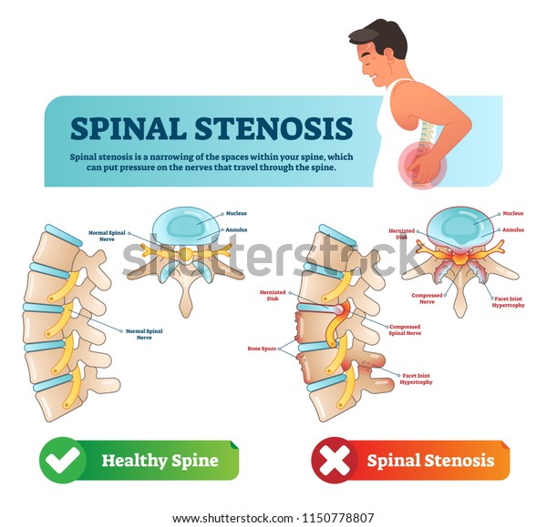 Spinal stenosis vector illustration. Labeled
medical scheme with explanation. Diagram with normal spinal nerve,
nucleus, annulus, bone spurs and compressed spinal nerve. Cause of
back and neck pain.