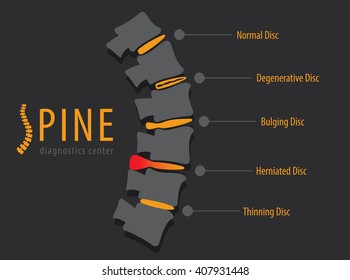 Spine Anatomy Disc Degeneration, Medical Conceptual Infographic Vector Illustration