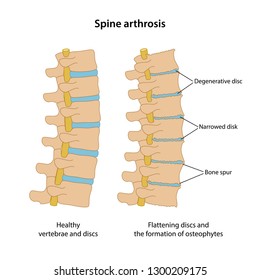 Spine arthrosis with main description. Healthy spine and spine with arthrosis in lateral view are isolated on white background. Vector illustration