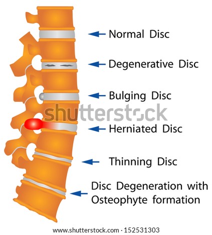 Spine conditions. Degenerative Disc. Bulging Disc. Herniated Disc. Thinning Disc. Disc Degeneration with Osteophyte formation Stock photo © 