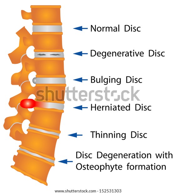 Image result for free images of herniated discs