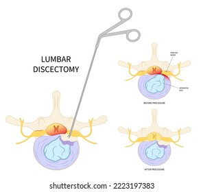 spine cord tumor cancer surgery lumbar laminectomy back nerve root pain disc cyst bone spurs vertebrae Muscle weakness diskectomy Anterior fusion replacement annular tear transforaminal compressed