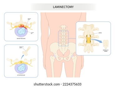 spine cord tumor cancer surgery lumbar laminectomy back nerve root pain disc cyst bone spurs vertebrae Muscle weakness diskectomy Anterior fusion replacement annular tear transforaminal compressed