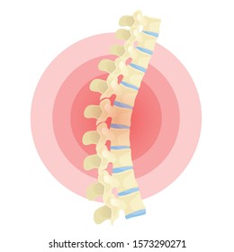 Spine deformation flat vector color isolated illustration. Kyphosis, back pain cartoon design element on white. Postural syndrome concept clipart. Spinal disease, disorder, posture problem