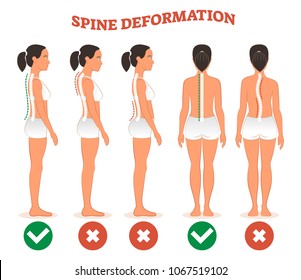 Spine deformation types and healthy spine comparison diagram poster with back bone curvatures. Female profile and back view. Chiropractic information.