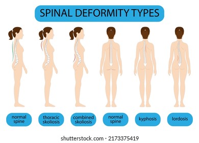 Spine Deformation Types And Healthy Spine Comparison Diagram Poster With Backbone Curvatures. Female Profile And Back View. Chiropractic Information