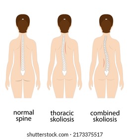 Spine Deformation Types And Healthy Spine Comparison Diagram Poster With Backbone Curvatures. Female Profile And Back View. Chiropractic Information