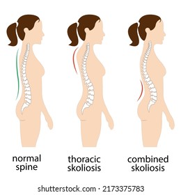 Spine Deformation Types And Healthy Spine Comparison Diagram Poster With Backbone Curvatures. Female Profile And Back View. Chiropractic Information