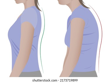 Spine Deformation Types And Healthy Spine Comparison Diagram Poster With Backbone Curvatures. Female Profile And Back View. Chiropractic Information