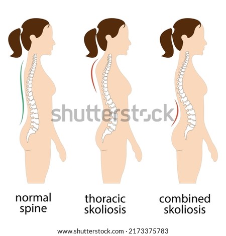 Spine deformation types and healthy spine comparison diagram poster with backbone curvatures. Female profile and back view. Chiropractic information