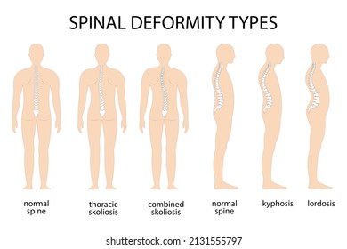 Spine deformity vector illustration. Kyphosis, lordosis spine infographic. Diagram with spine curvature and healthy spine. Posture defect. Medical, educational and scientific banner