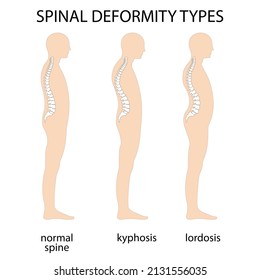 Spine Deformity Vector Illustration Kyphosis Lordosis Stock Vector ...