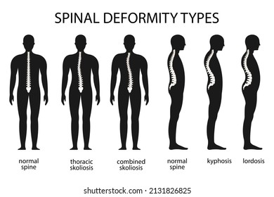 407 Doctor Spine Deformity Images, Stock Photos & Vectors | Shutterstock