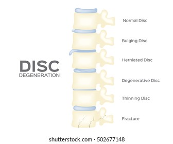 spine disc degeneration vector . back bone . organ anatomy