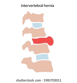 Wirbelsäulenkrankheit, Rückgrat mit hernisierter Scheibe. Konzeption, Therapie und Behandlung von intervertebralen Hernien in der Wirbelsäulenklinik. Rückenschmerzen und Diagnose. Anatomie menschlicher Wirbeltiere, flache medizinische Vektorgrafik