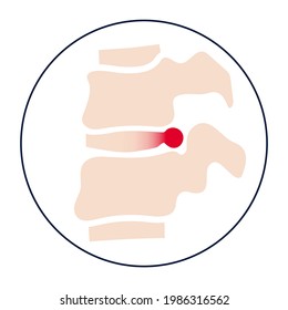 Spine disease, backbone with herniated disc. Intervertebral hernia concept, therapy and treatment in spine clinic. Spinal pain and diagnosis. Human vertebrae anatomy flat medical vector illustration