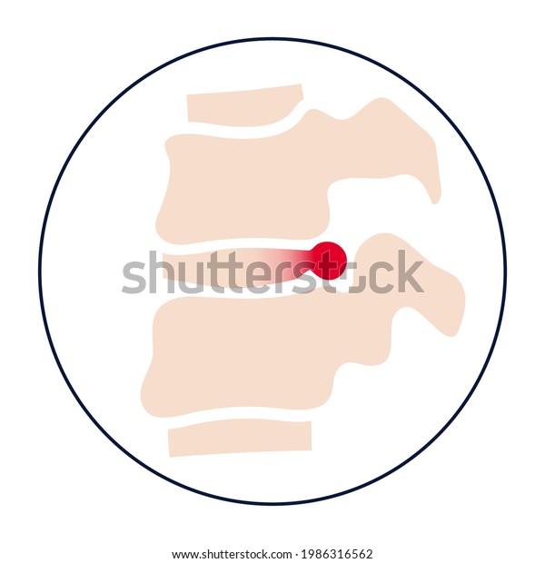 Spine Disease Backbone Herniated Disc Intervertebral Stock Vector ...
