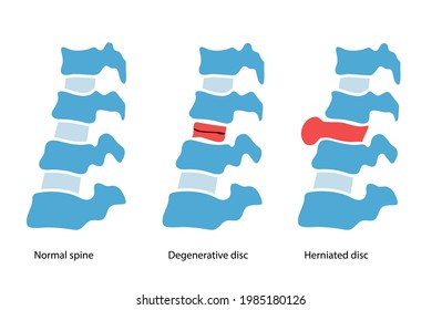 Spine disease, normal backbone, degenerative disc and herniated disc. Intervertebral hernia concept, therapy and treatment in spine clinic. Human vertebrae anatomy. Medical flat vector illustration