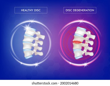 Spine disease, normal backbone, degenerative disc and herniated disc. Skeleton x ray scan concept. Human vertebrae anatomy medical flat. 3D Vector illustration