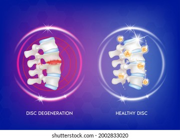 Spine disease, normal backbone, degenerative disc and herniated disc. Skeleton x ray scan concept and Vitamin therapy. Human vertebrae anatomy. Medical flat vector illustration