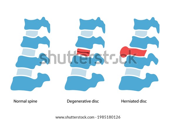 Spine Disease Normal Backbone Degenerative Disc Stock Vector (Royalty ...