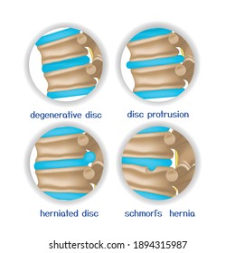 Spine diseases. Various pathologies of intervertebral discs and bones. 4 round icons. Vector illustration.