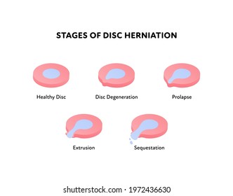 Spine disk stages of herniation. Vector flat anatomical illustration. Icon set. Healthy, degeneration, prolapse, protrusion, sequestation stage. Design for science, biology, health care.