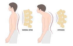 Spine Forward Head Posture Chest Xray Neck Pain Lumbar Scheuermann's Body Discs Brace Sway Back Adam's Spinal Birth Defect Fracture Cobb Angle Bone Curved Vertebrae Cancer Bend Test Exam Kyphoplasty