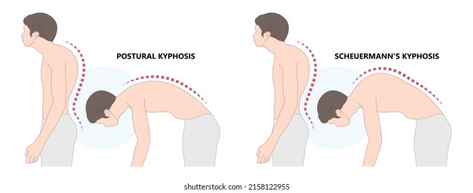 spine forward head posture chest xray neck pain lumbar Scheuermann's body discs brace sway back adam's spinal birth defect fracture cobb angle bone curved vertebrae cancer bend test exam kyphoplasty