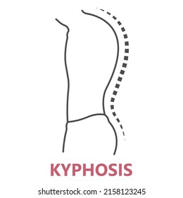 spine forward head posture chest xray neck pain lumbar Scheuermann's body discs brace sway back adam's spinal birth defect fracture cobb angle bone curved vertebrae cancer bend test exam kyphoplasty