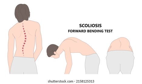 spine forward head posture chest xray neck pain lumbar Scheuermann's body discs brace sway back adam's spinal birth defect fracture cobb angle bone curved vertebrae cancer bend test exam kyphoplasty