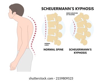 Anatomía de la enfermedad de la columna vertebral de la kyphosis de scheuermann que causa dolor y coloración de la parte superior de la espalda