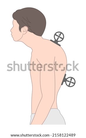 spine forward head posture chest xray neck pain lumbar Scheuermann's body discs brace sway back adam's spinal birth defect fracture cobb angle bone curved vertebrae cancer bend test exam kyphoplasty