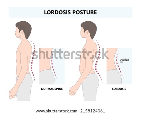 spine forward head posture chest xray neck pain lumbar Scheuermann's body discs brace sway back adam's spinal birth defect fracture cobb angle bone curved vertebrae cancer bend test exam kyphoplasty