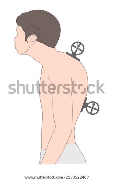 spine forward head posture chest xray neck\
pain lumbar Scheuermann\'s body discs brace sway back adam\'s spinal\
birth defect fracture cobb angle bone curved vertebrae cancer bend\
test exam kyphoplasty