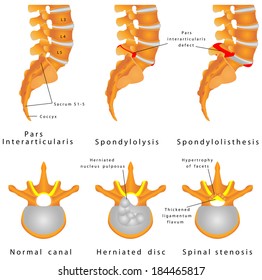 Spine Fracture. Spondylolysis (Spondylolisthesis) Is A Defect In The Bony Ring Comprising The Spinal Column. Displacement Of A Lumbar Vertebra, Most Commonly Occurring After A Break Or Fracture.